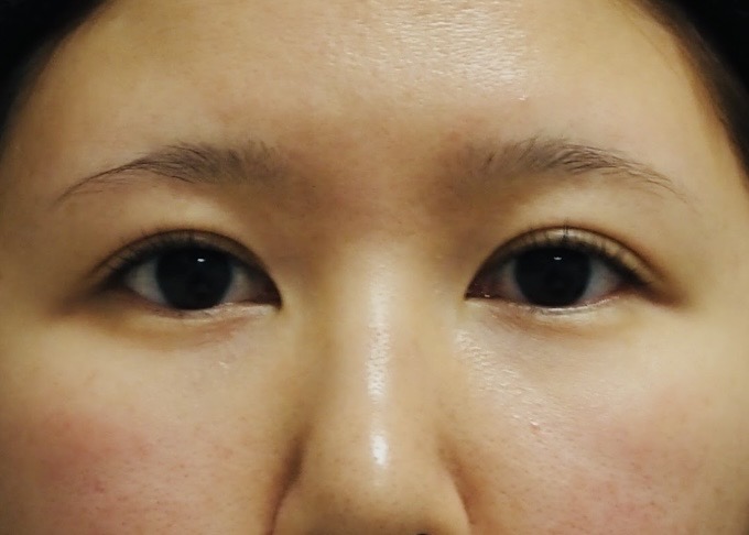 グラマラスライン＋目尻切開の術前写真