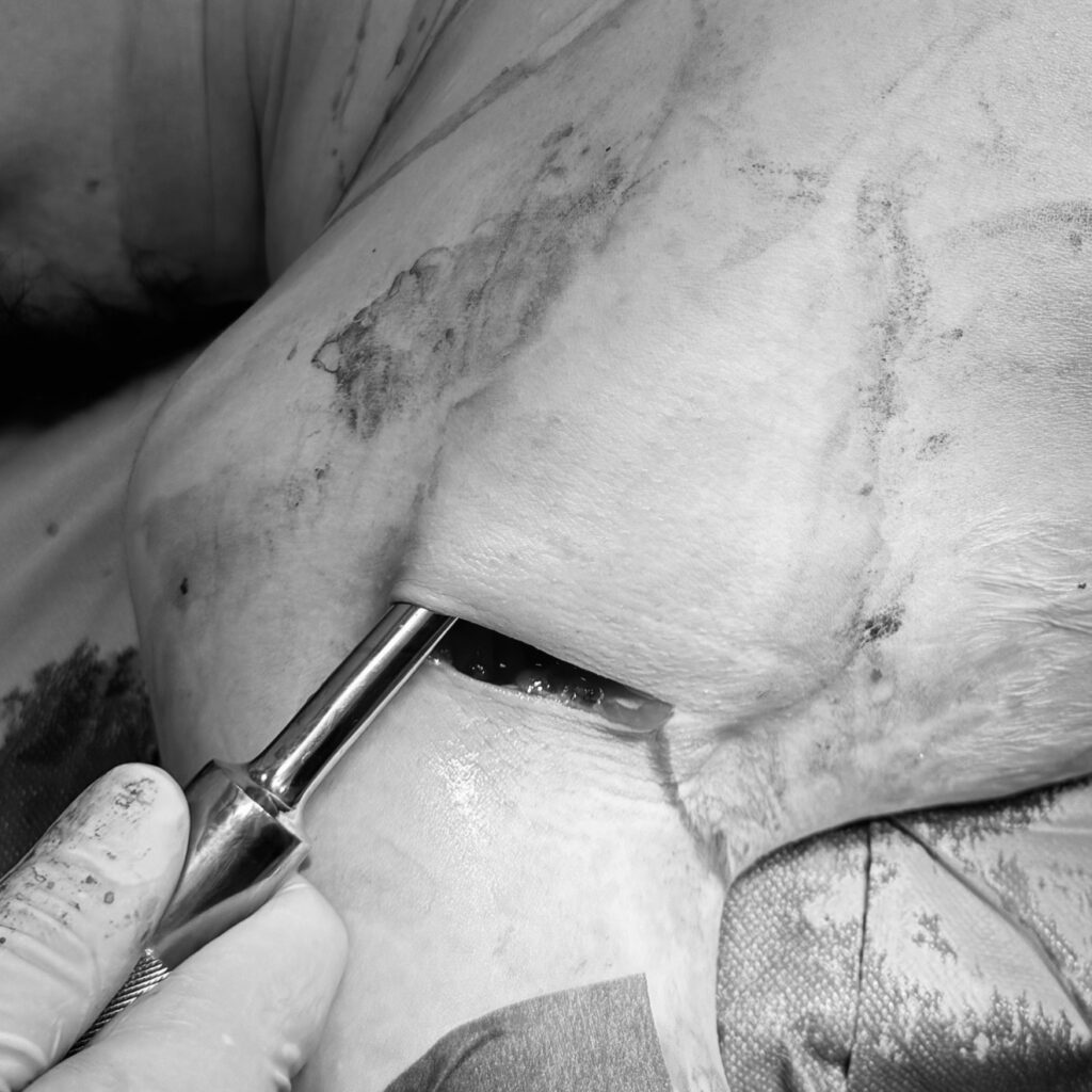 シリコン豊胸のため、乳腺下または大胸筋下を剥離している画像