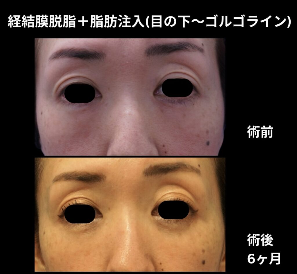 経結膜脱脂術+脂肪注入(目の下からゴルゴラインにかけて)の症例