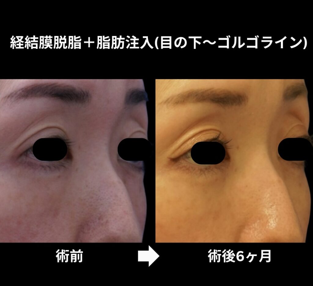 経結膜脱脂術+脂肪注入(目の下からゴルゴラインにかけて)の症例