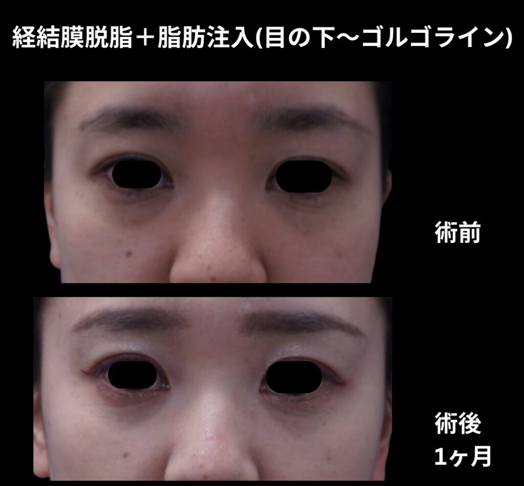 経結膜脱脂術+脂肪注入(目の下からゴルゴラインにかけて)の症例