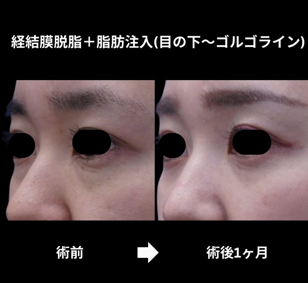 経結膜脱脂術+脂肪注入(目の下からゴルゴラインにかけて)の症例