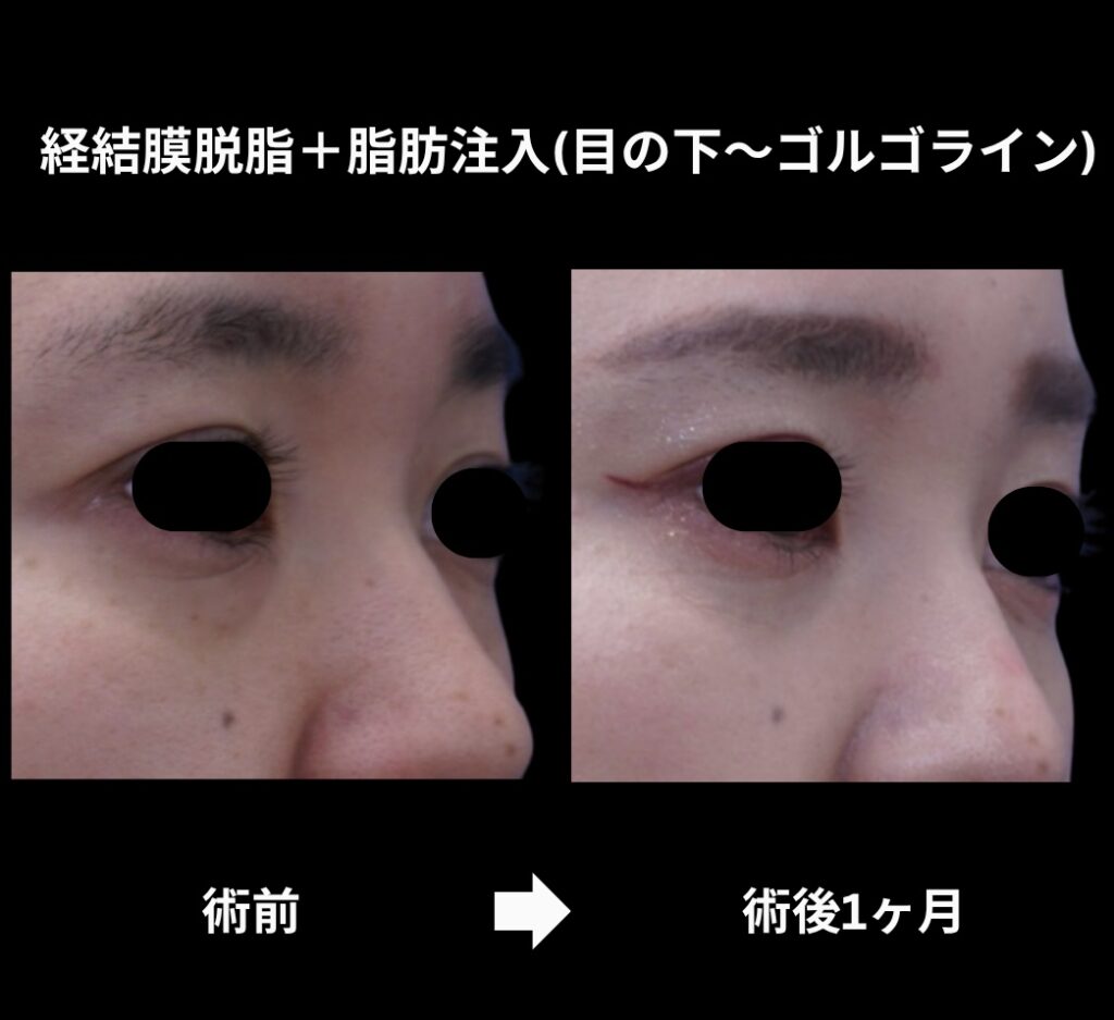 経結膜脱脂術+脂肪注入(目の下からゴルゴラインにかけて)の症例