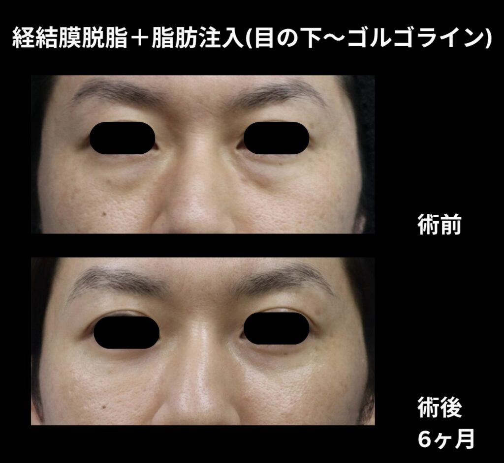 経結膜脱脂術+脂肪注入(目の下からゴルゴラインにかけて)の症例