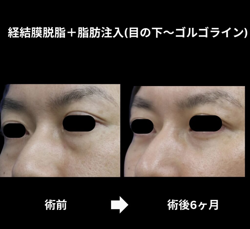 経結膜脱脂術+脂肪注入(目の下からゴルゴラインにかけて)の症例