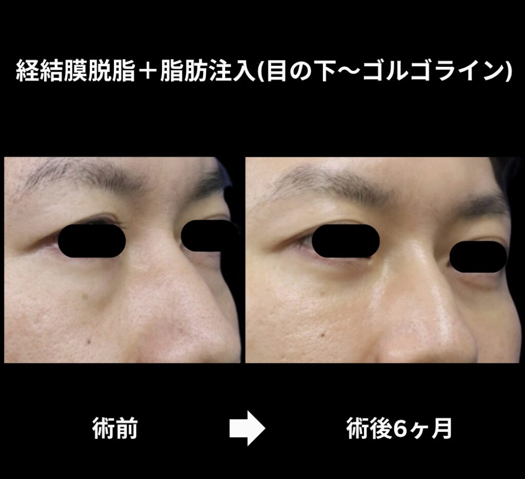経結膜脱脂術+脂肪注入(目の下からゴルゴラインにかけて)の症例
