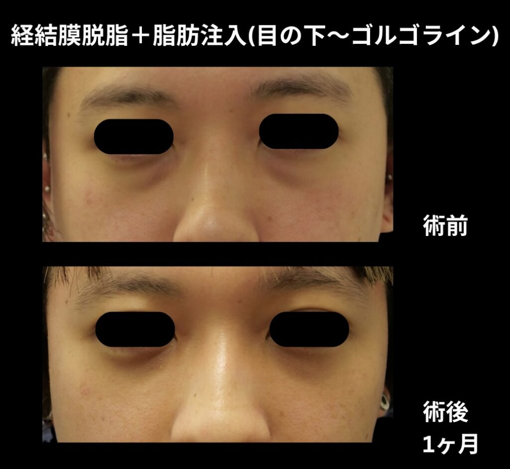 経結膜脱脂術+脂肪注入(目の下からゴルゴラインにかけて)の症例