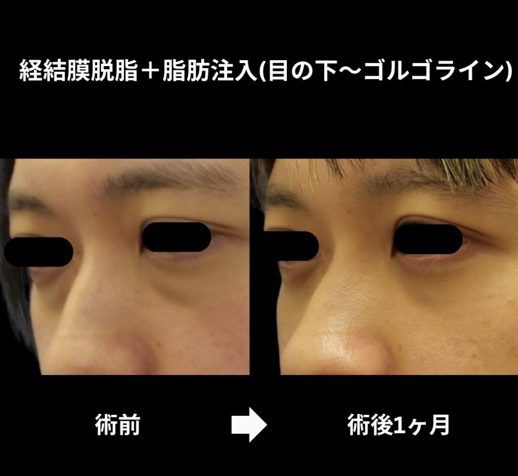 経結膜脱脂術+脂肪注入(目の下からゴルゴラインにかけて)の症例