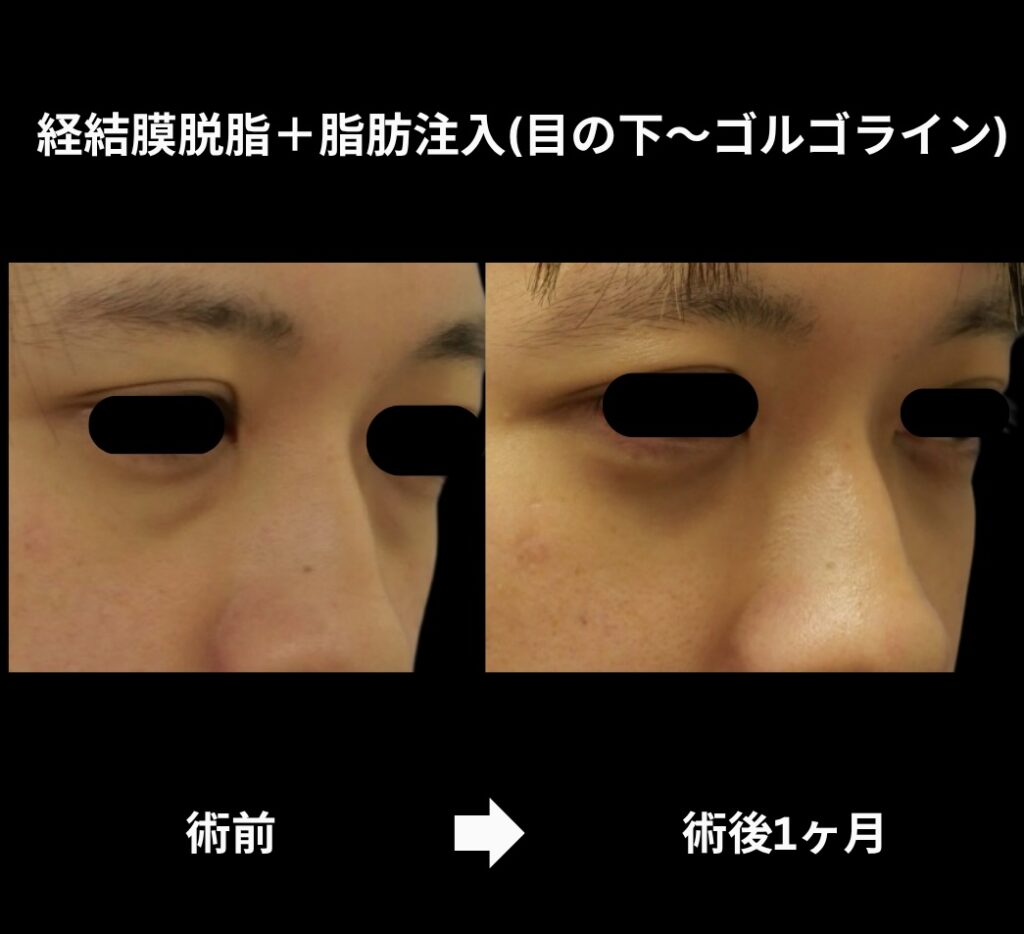経結膜脱脂術+脂肪注入(目の下からゴルゴラインにかけて)の症例