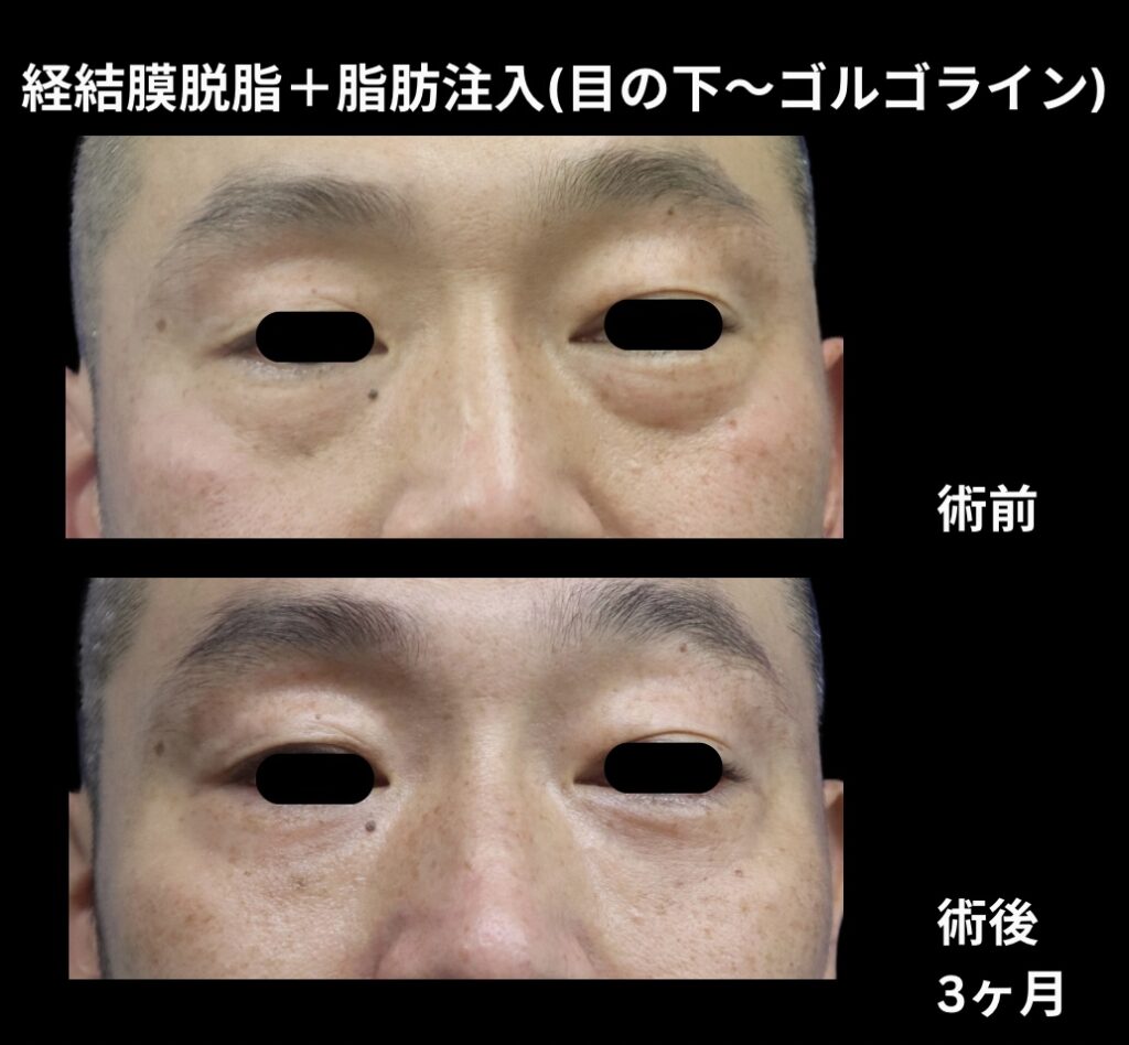 経結膜脱脂術+脂肪注入(目の下からゴルゴラインにかけて)の症例