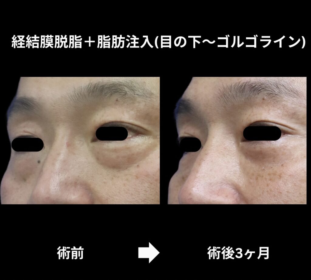 経結膜脱脂術+脂肪注入(目の下からゴルゴラインにかけて)の症例