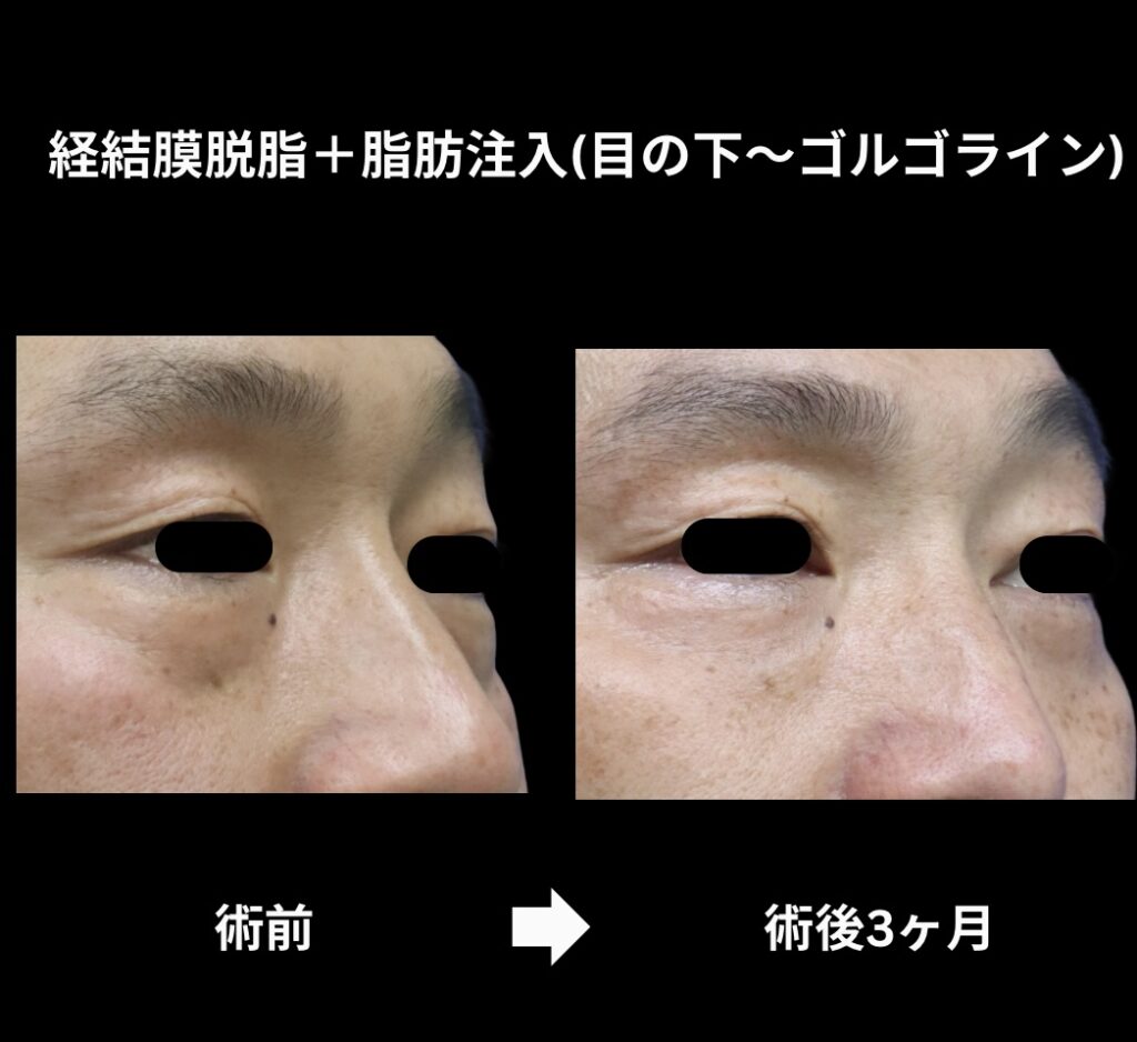 経結膜脱脂術+脂肪注入(目の下からゴルゴラインにかけて)の症例