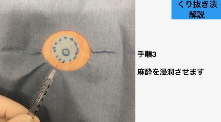 下北沢粉瘤麻酔