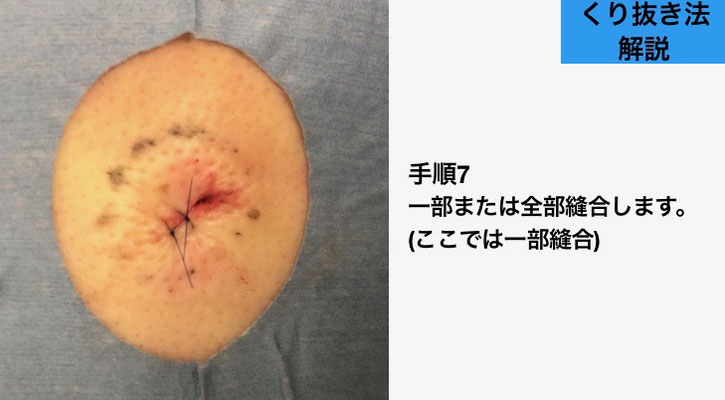 下北沢粉瘤日帰り手術