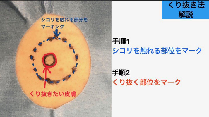 下北沢粉瘤手術