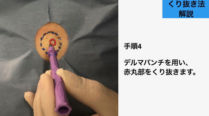 下北沢粉瘤くり抜き