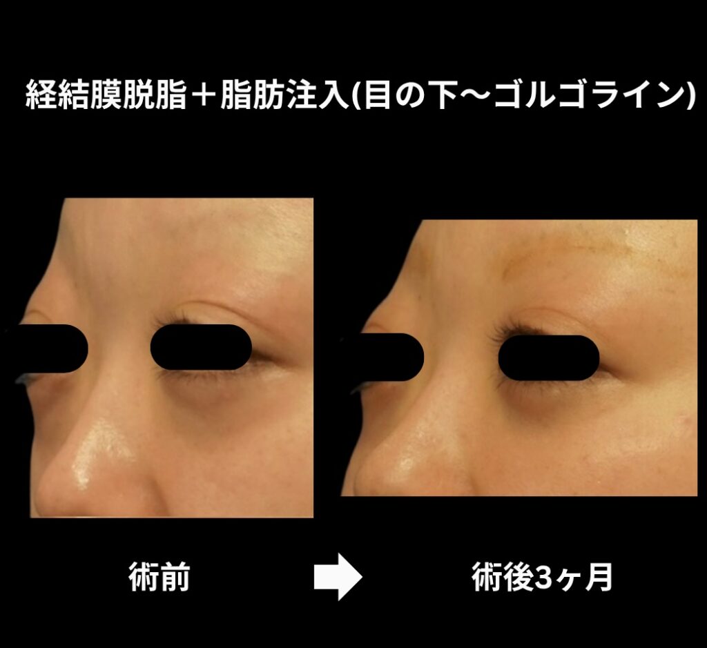 経結膜脱脂術+脂肪注入(目の下からゴルゴラインにかけて)の症例