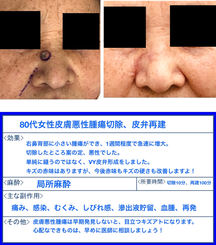 80代女性の皮膚悪性腫瘍切除術+皮弁再建の症例写真