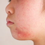 肌の赤みへの治療について