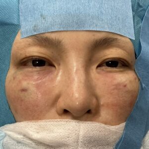 脂肪注入終了後