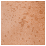 しみ、くすみ治療