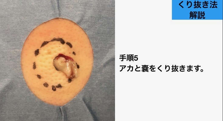 下北沢粉瘤くり抜き手術
