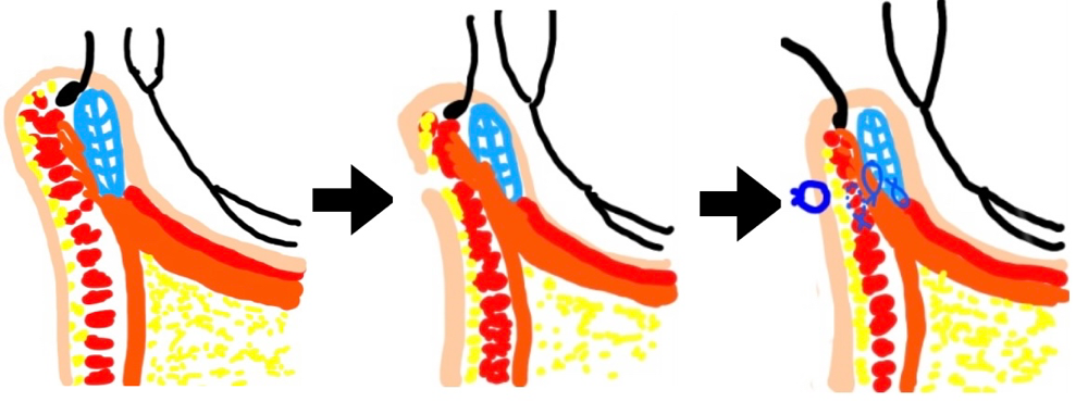 眼瞼内反に対する治療法