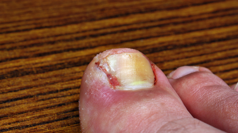 巻き爪・陥入爪