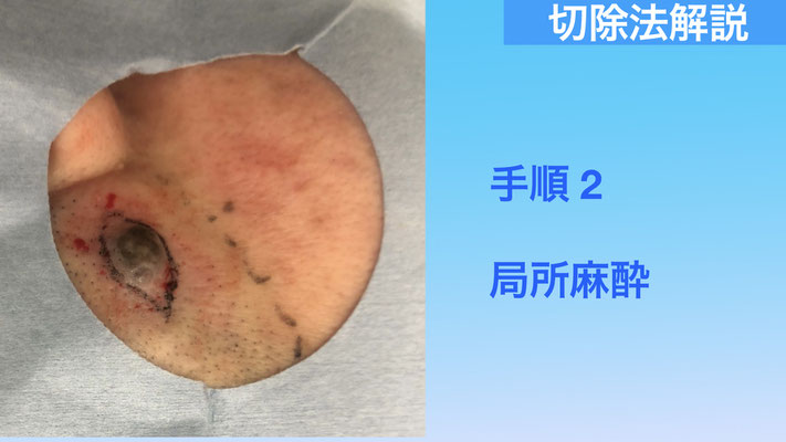 下北沢ほくろ切除