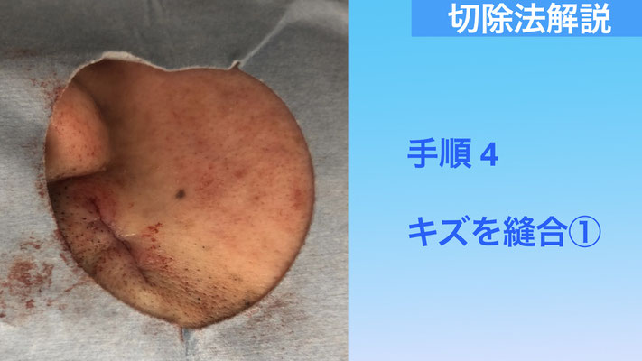 下北沢ほくろ縫合