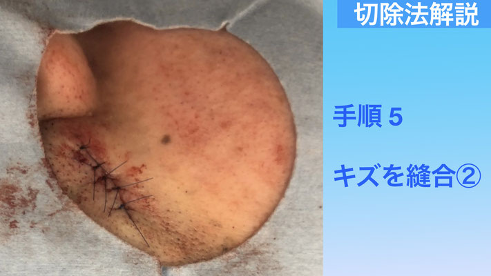 下北沢ほくろ縫合後