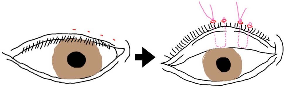 睫毛内反症に対する埋没法