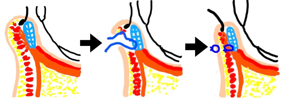 睫毛内反に対するHotz法