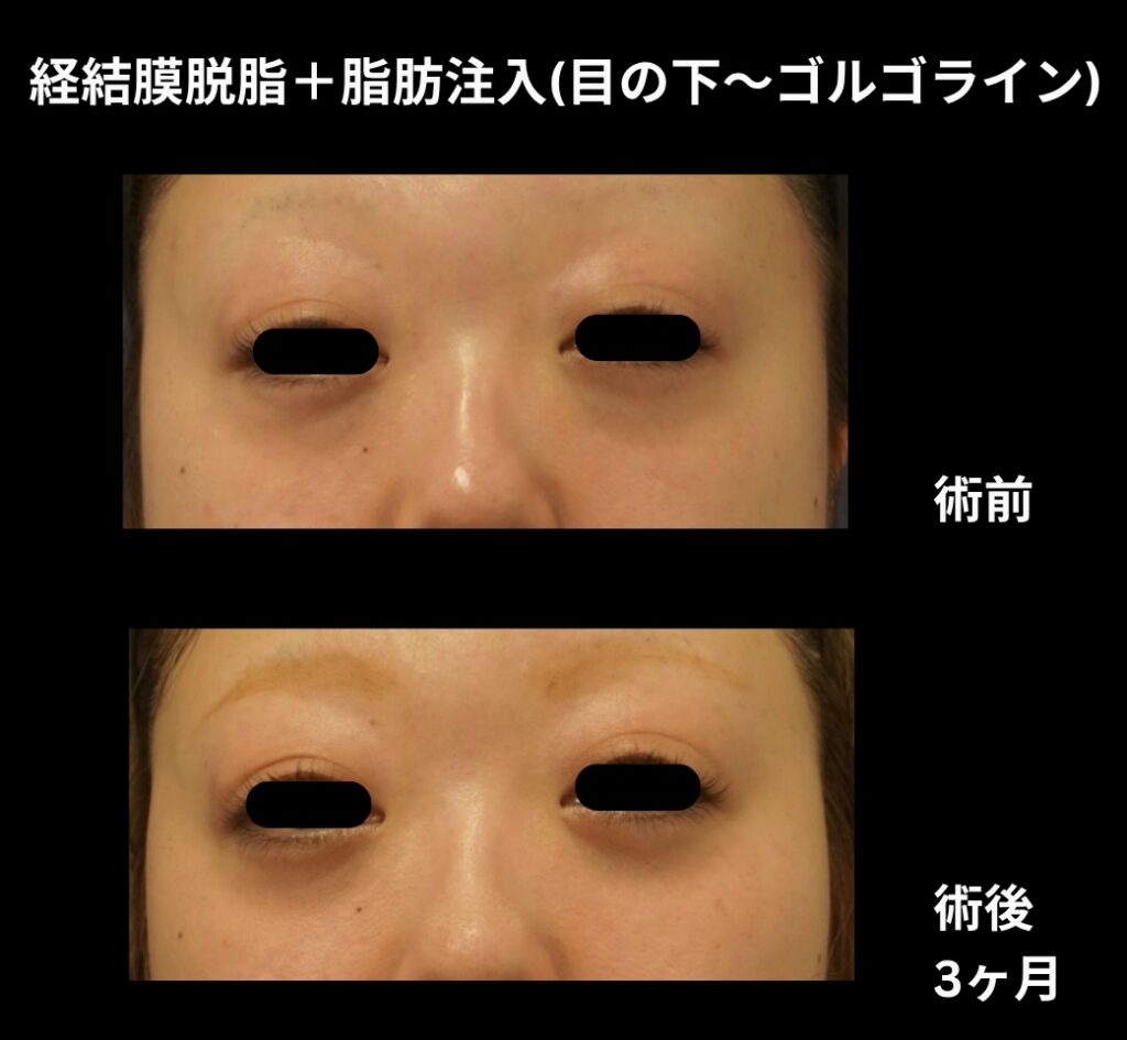 経結膜的脱脂術+脂肪注入(目の下〜ゴルゴライン)の症例写真