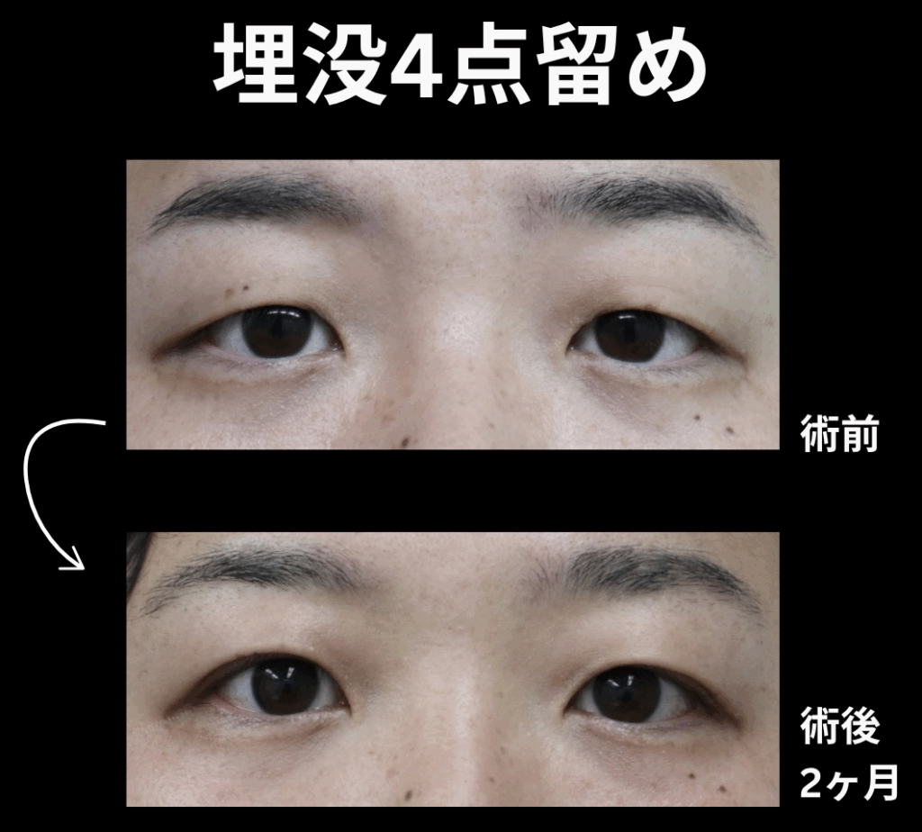 埋没法4点留めの症例写真