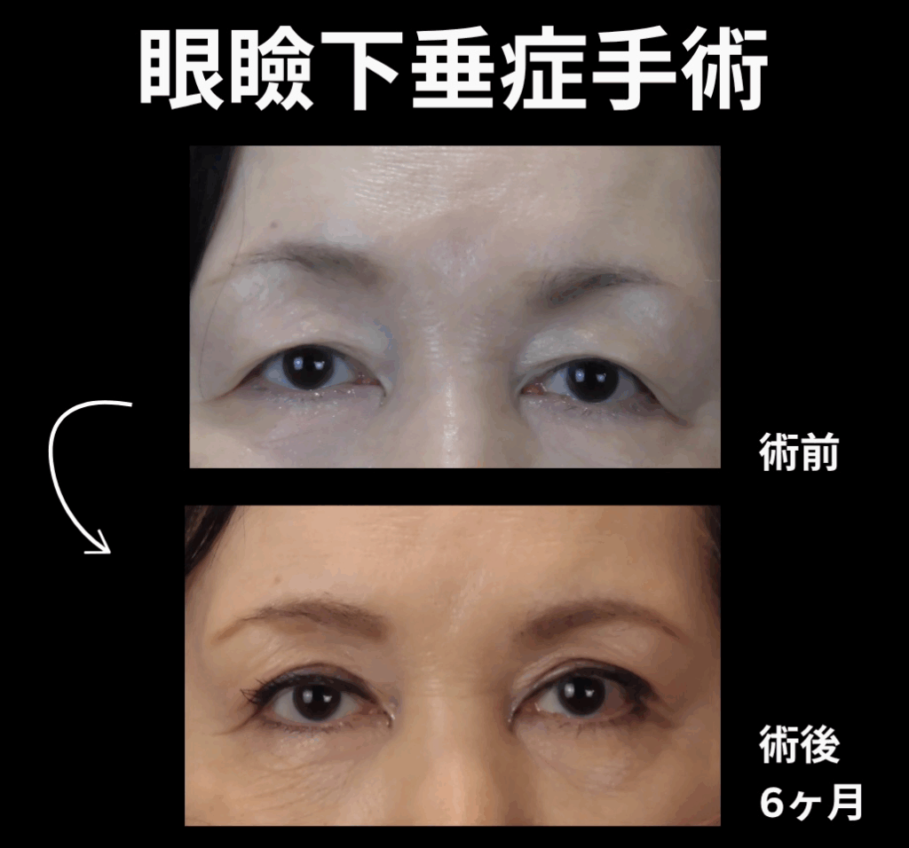 世田谷下北沢眼瞼下垂手術