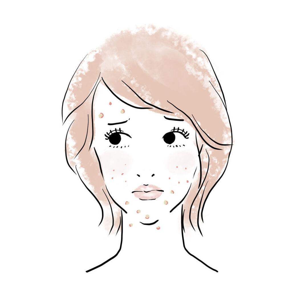 蕁麻疹に悩む女性のイメージ