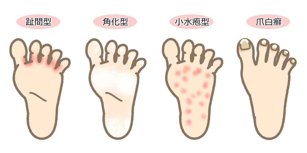 水虫のタイプ