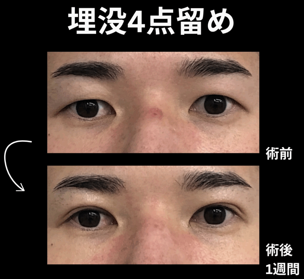 埋没法4点留めの症例写真