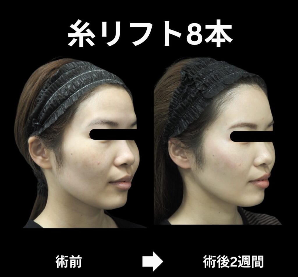 糸リフトの症例写真