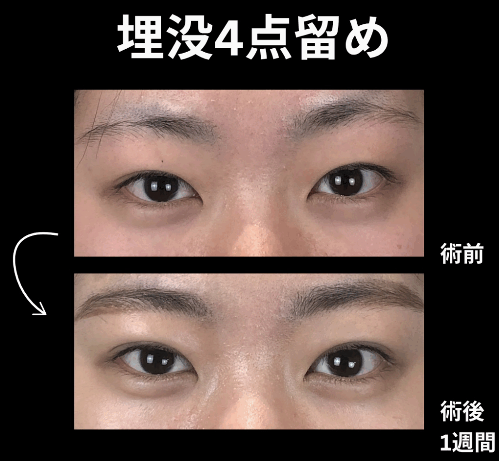 埋没法4点留目の症例写真