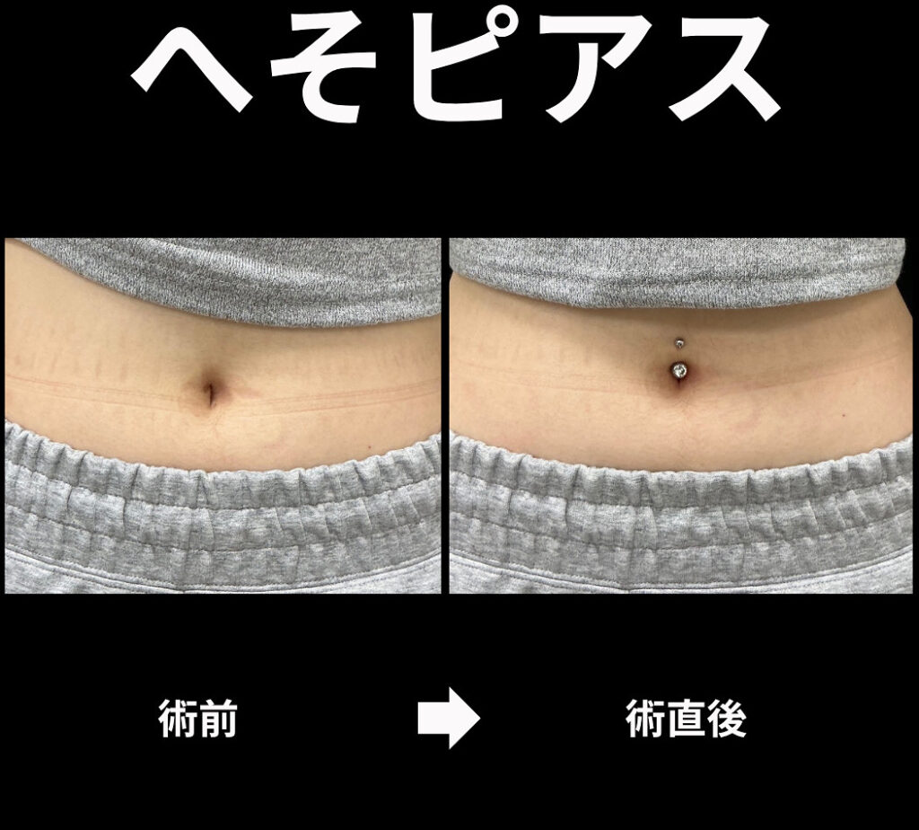 へそピアスの症例写真