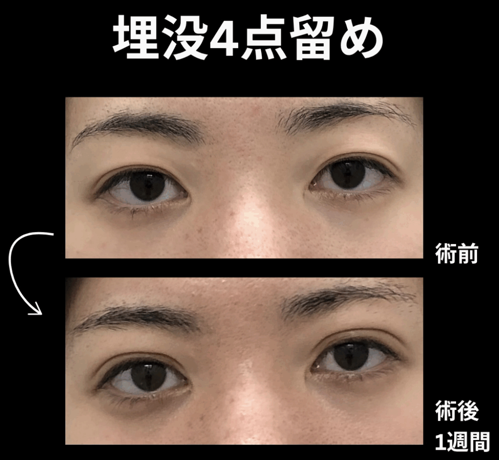 埋没法4点留めの症例写真