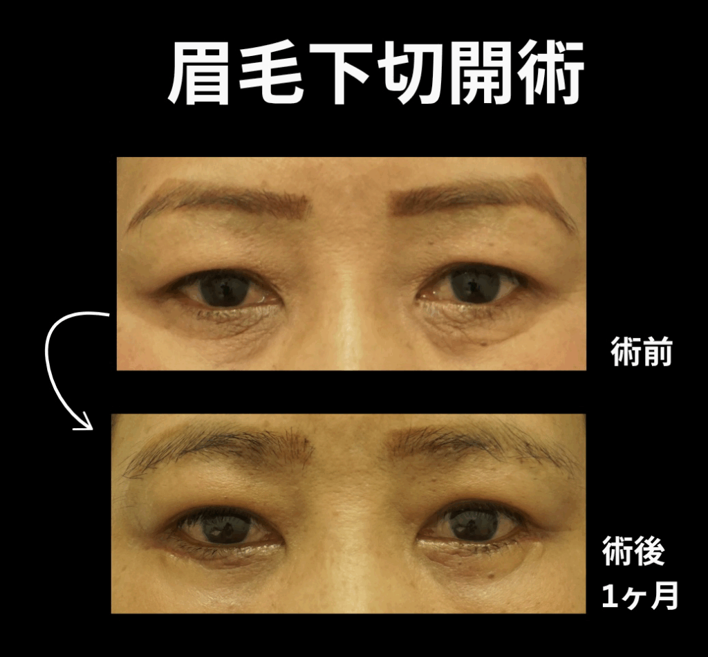 世田谷下北沢眉下切開手術