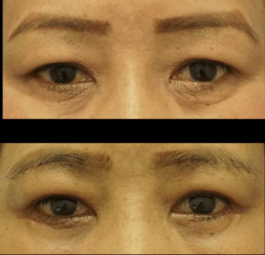 世田谷下北沢眉下切開手術