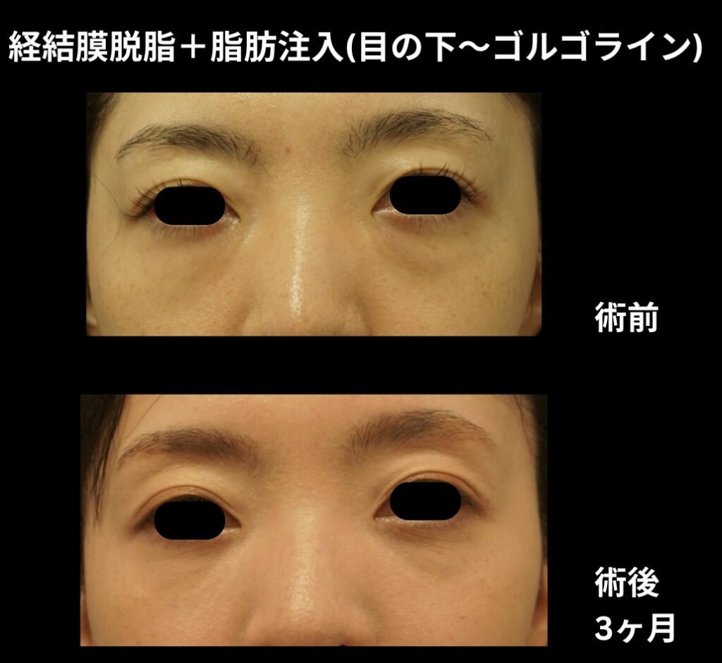 経結膜脱脂術＋脂肪注入（目の下からゴルゴラインにかけて）の症例
