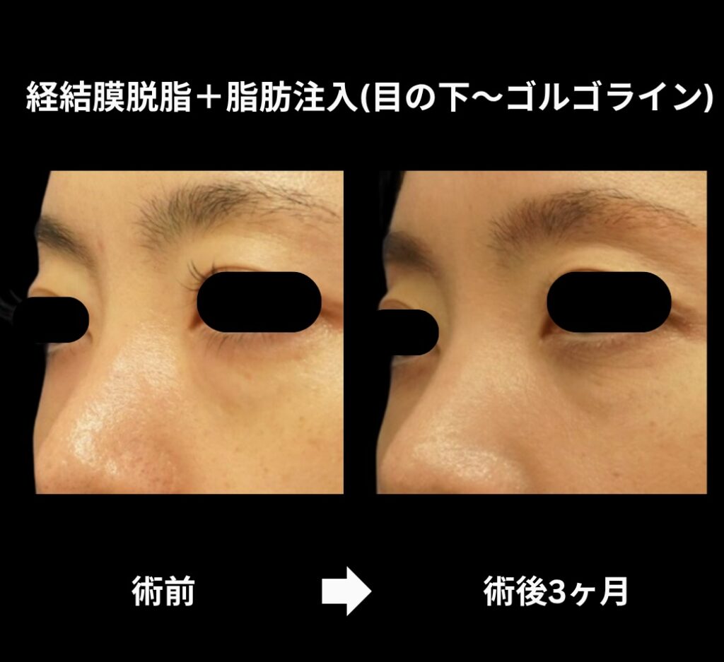 経結膜脱脂術＋脂肪注入（目の下からゴルゴラインにかけて）の症例