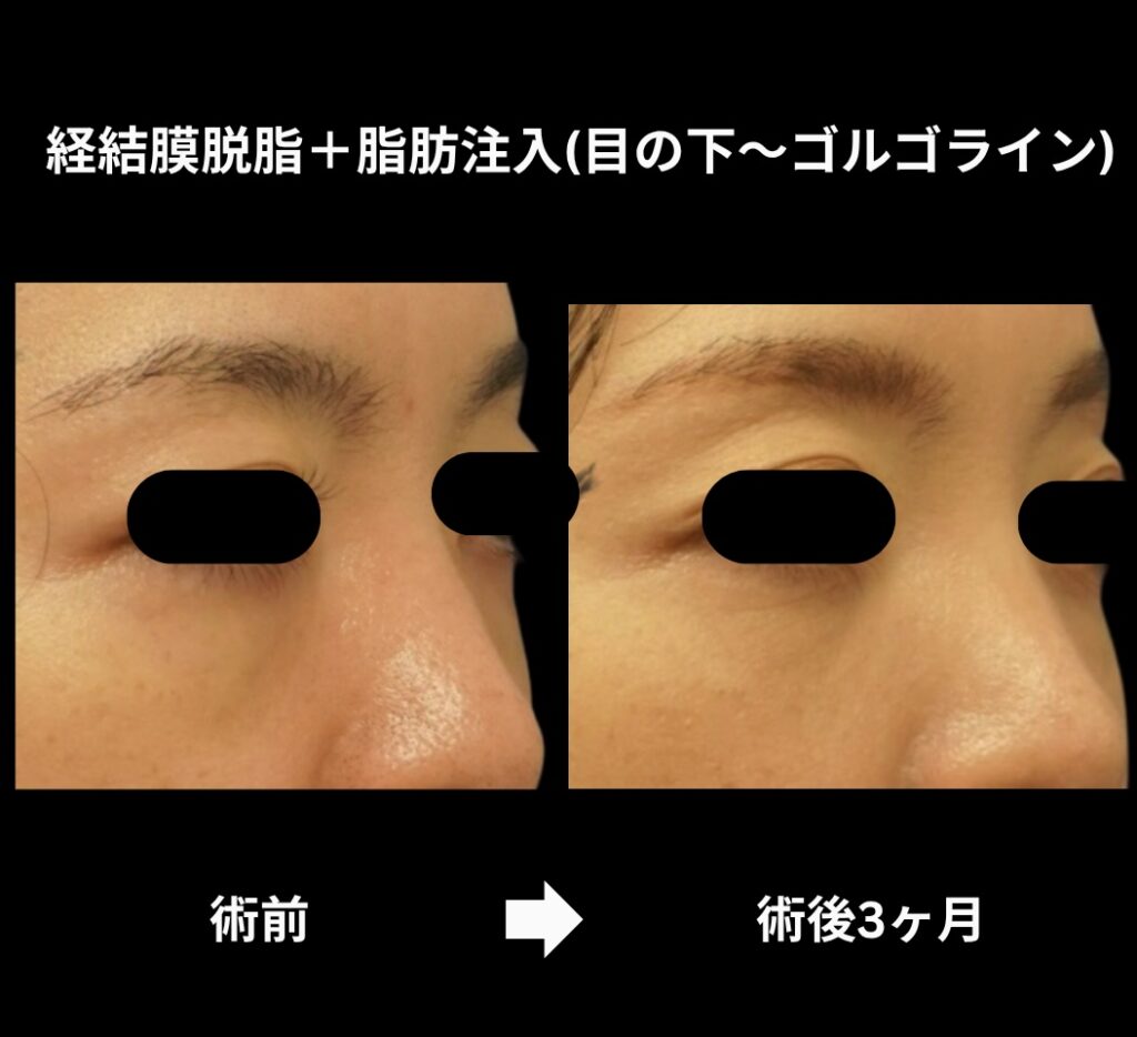 経結膜脱脂術＋脂肪注入（目の下からゴルゴラインにかけて）の症例