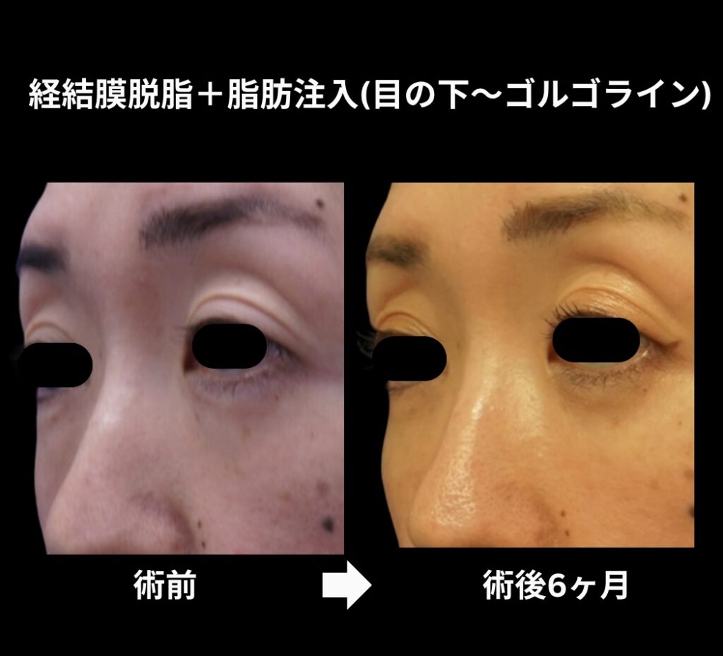 経結膜的脱脂術+脂肪注入(目の下からゴルゴライン)