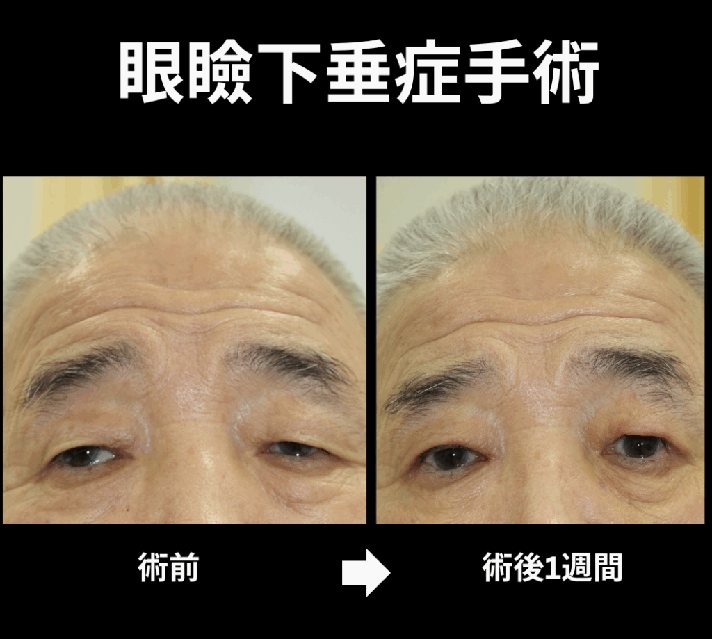 世田谷下北沢眼瞼下垂手術症例